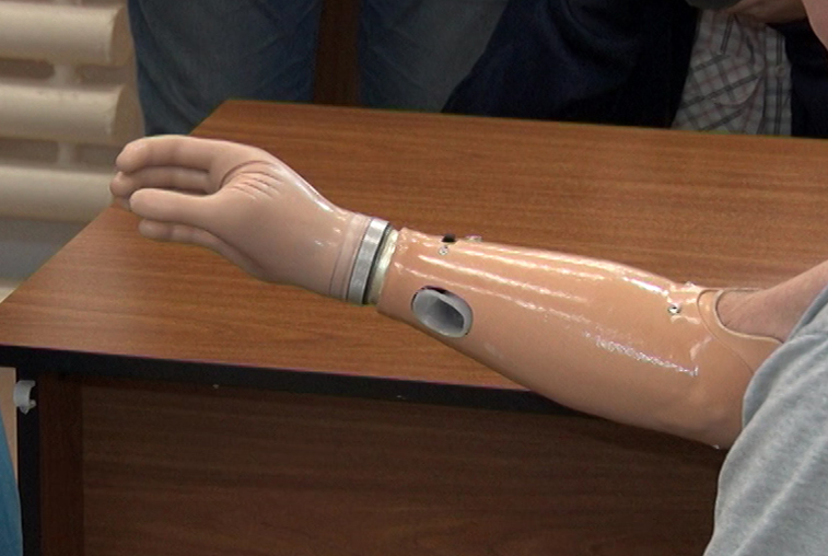 Специалисты из Сколково установили бионические протезы 4 амурчанам - gtrkamur.ru